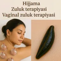 Rayyon hijama va zuluk