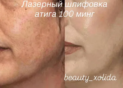 Лазерная шлифовка лица 1