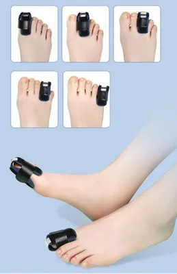 Oyoq barmoqlari uchun fiksator-ortez, gips o‘rniga korset 1
