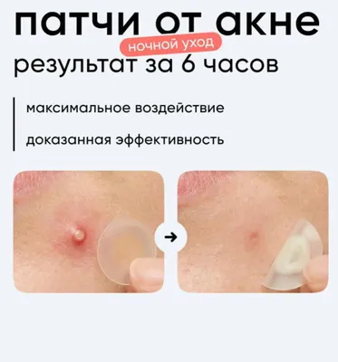 От угрей 1