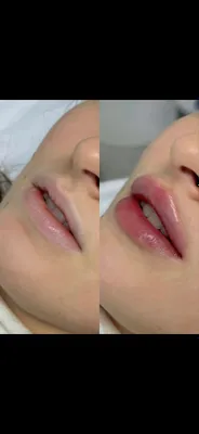 Увеличение губ, контурная пластика 1