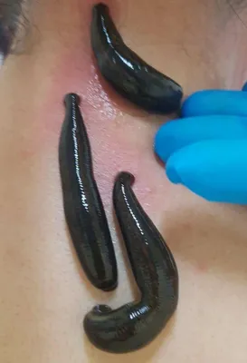 Зулук. Шуллук. Пиявки 1