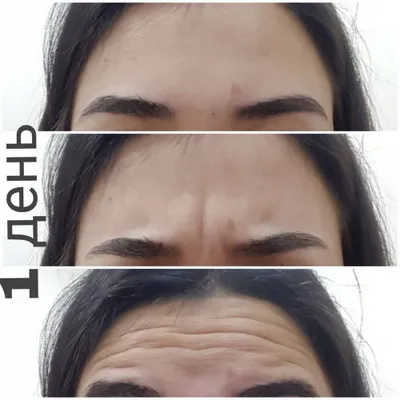 Botoks | Toshkent kosmetologi | 1