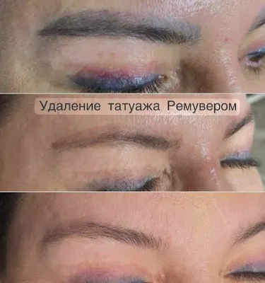 Удаление татуажа ремувером