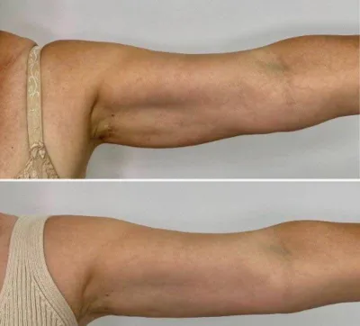 RF-lifting, taranglashtirish, kollagen — sizning kosmetologingiz 1