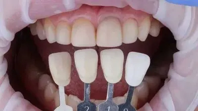 CAD/CAM tish texnigi: stomatologiya, tsirkoniy, PMMA tishlar, 3D Pro MT ST HT