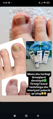 oyoq sasisi va ko'p terlashni hamda griboklarga