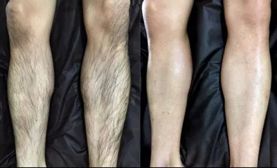 Эпиляция Депиляция
