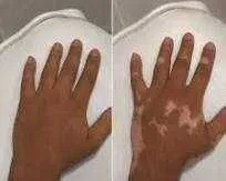 Vitiligo uchun kamuflyaj bo‘yash 1