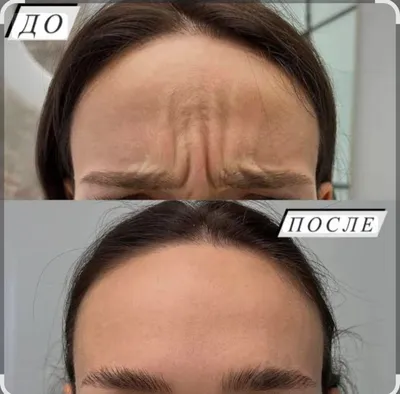 Ботокс лица, мезоботокс, full face 1