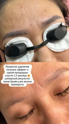 Qosh tatuirovkasini, shuningdek o‘rtacha kattalikdagi tatuirovkalarni olib tashlash 1