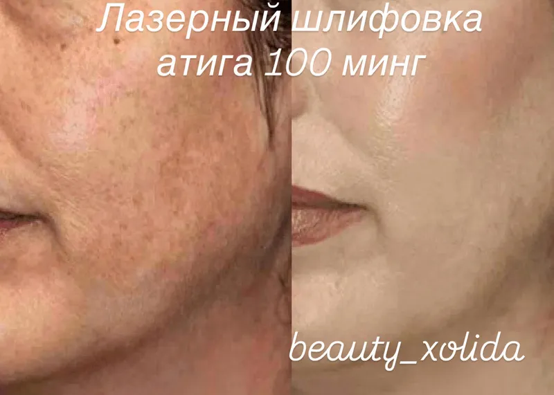 Лазерный шлифовка юз