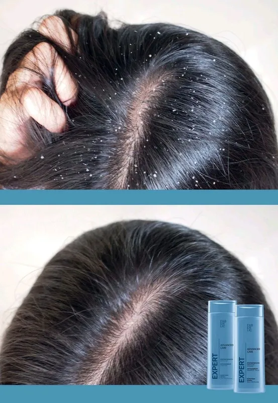 1da2 Expert Advanced Care qazg'oqga qarshi shampun — фото 3