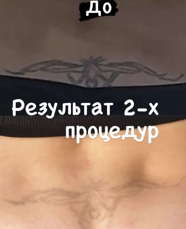 Удаление татуаж татуировок за 2 процедуры безболезненно