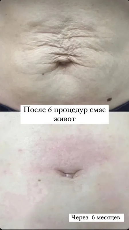 SMAS СМАС омоложение — фото 5