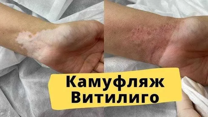 Vitiligo kamuflyaji — фото 2
