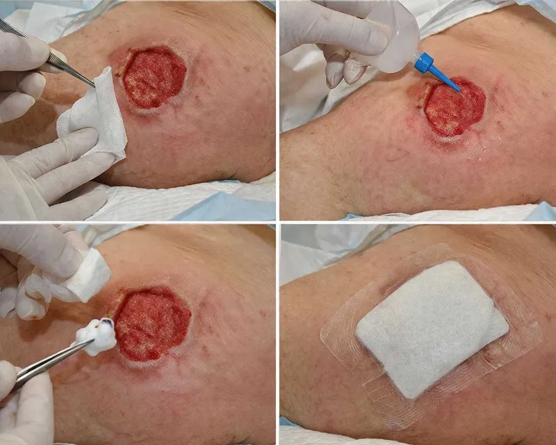 Обработка ран и пролежней