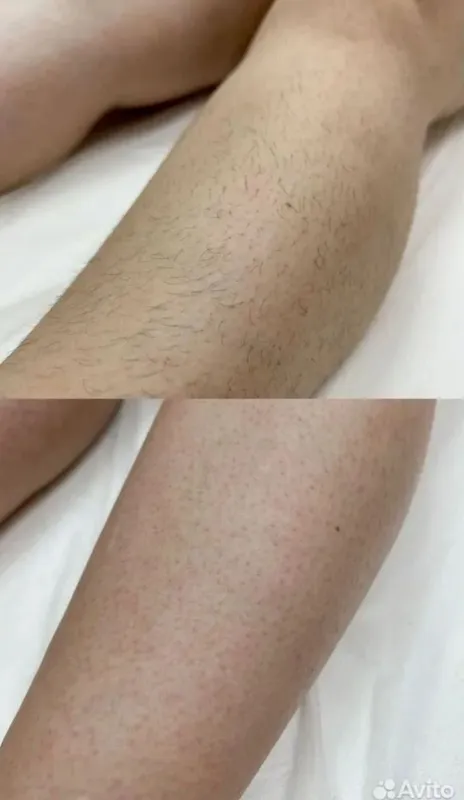 Депиляция эркак айол 2 Депиляция эркак айол 2