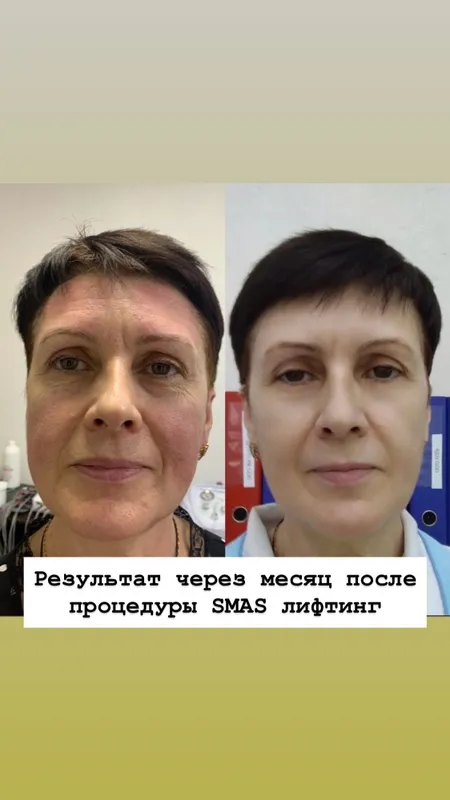 SMAS СМАС омоложение — фото 9