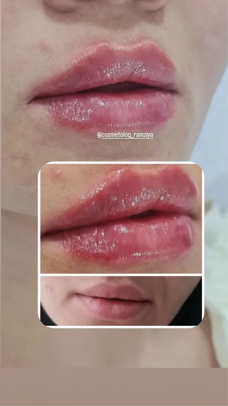 Губки , филлер, ботокс . Качественно! 5
