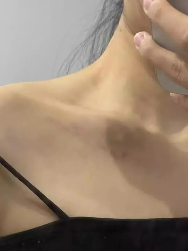Татуаж удаление 2 Татуаж удаление 2