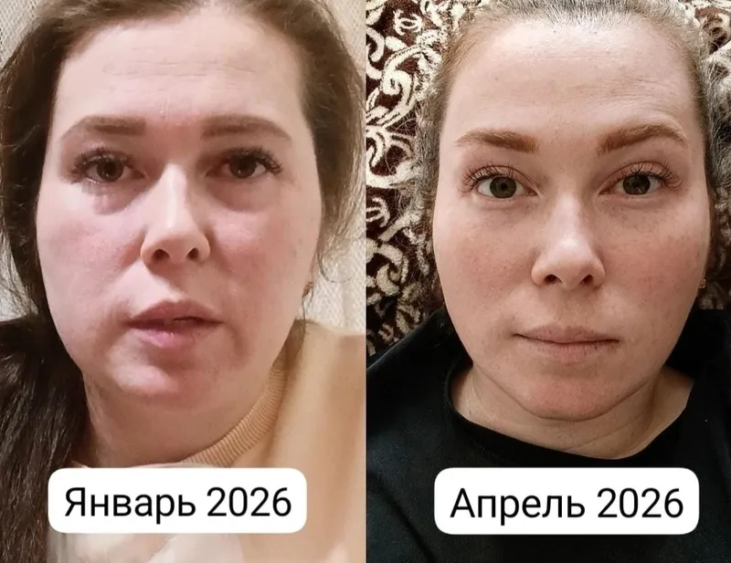 Набор от отёков dreineffect и патчи
