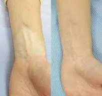 Vitiligo kamuflyaji