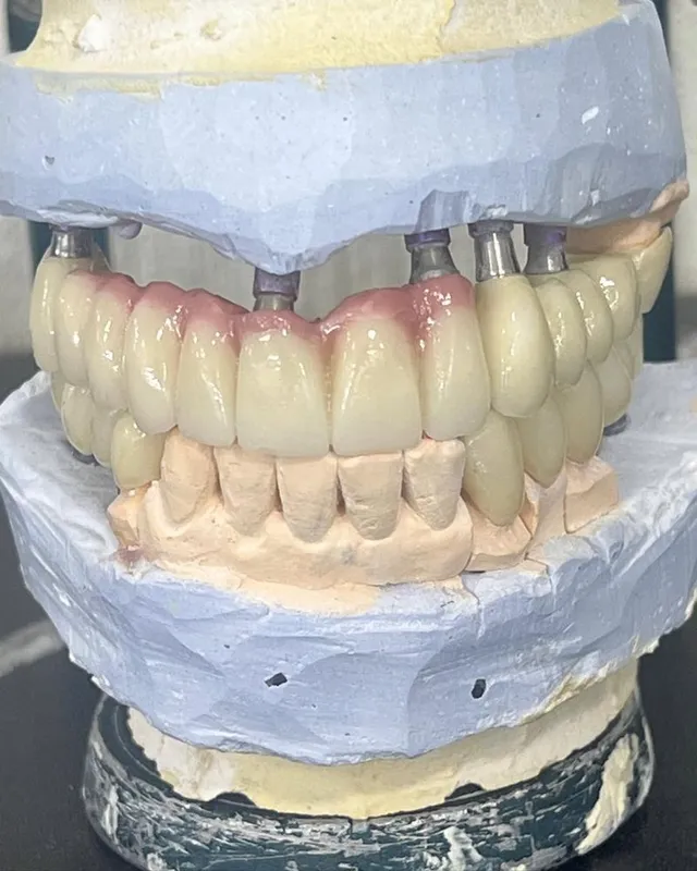 Цирконий / E-max за 2–3 дня | Luminora Dental — фото 4