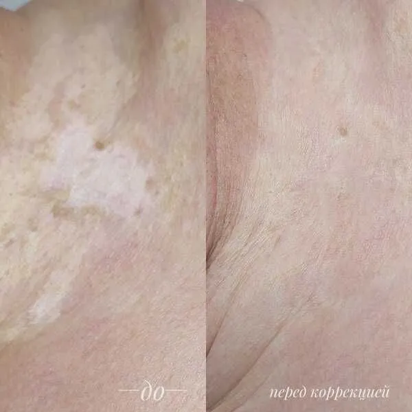 Vitiligo kamuflyaji — фото 1