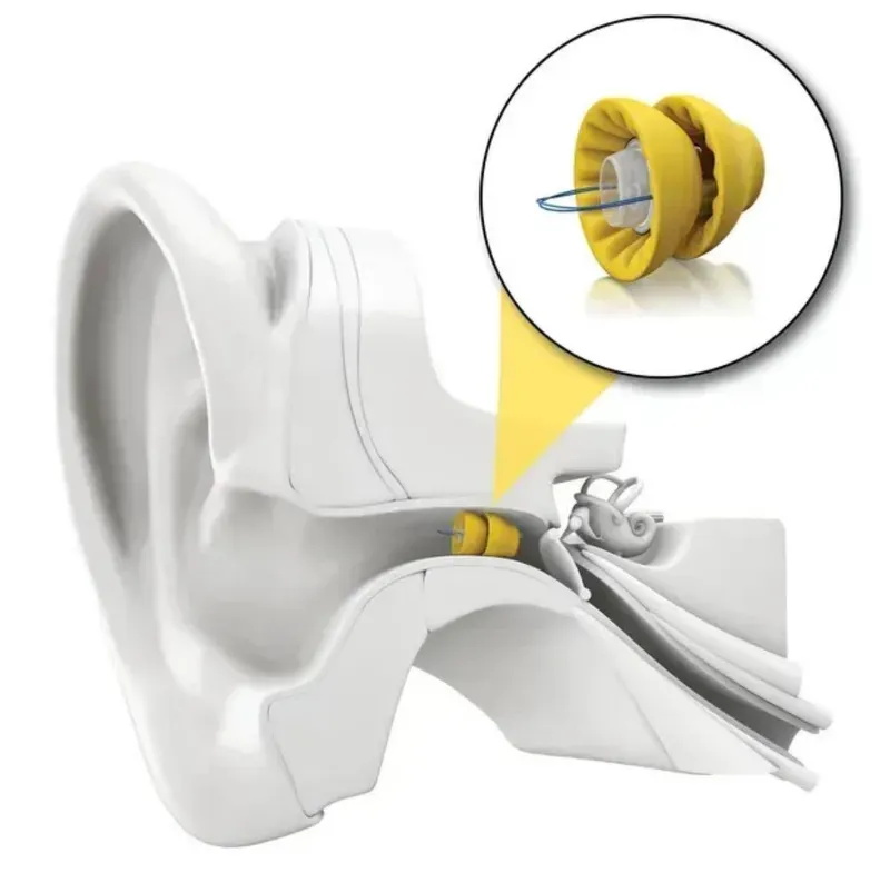 Phonak Lyric™ Слуховой аппарат