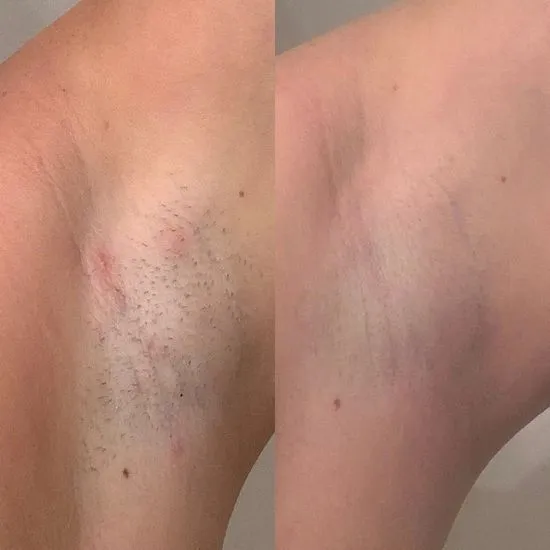 Laser epilyatsiya tuklarsan og'riqsiz va oson xolos buling — фото 1
