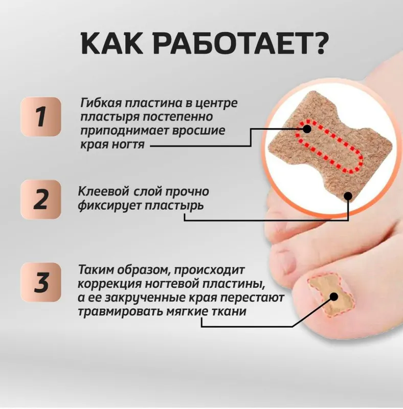 Bosh barmoqning ichga o‘sib kirgan tirnog‘i uchun plastir-korrektor 2