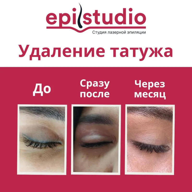 Удаление татуажа