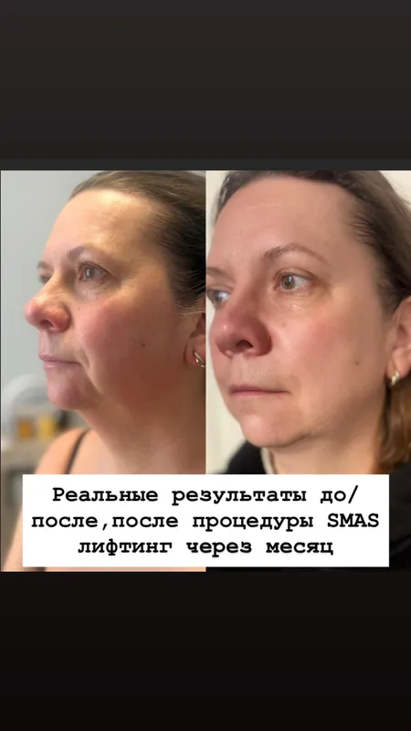 SMAS СМАС омоложение — фото 4