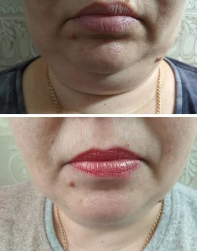 Липолитики. Живот, бедра, лицо, второй подбородок. 2