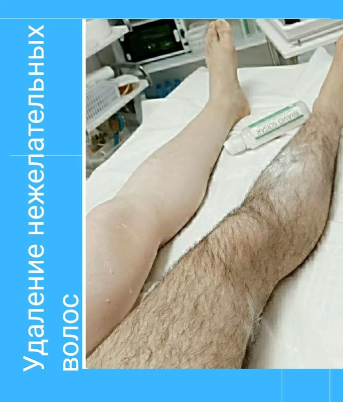 Депиляция мужчинам 2 Депиляция мужчинам 2