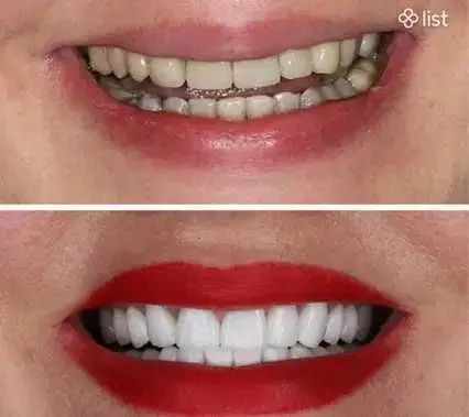 Frezer markazi tish-texnika laboratoriyasi CAD/CAM zirkondan tojlar Frezer markazi tish-texnika laboratoriyasi CAD/CAM zirkondan tojlar