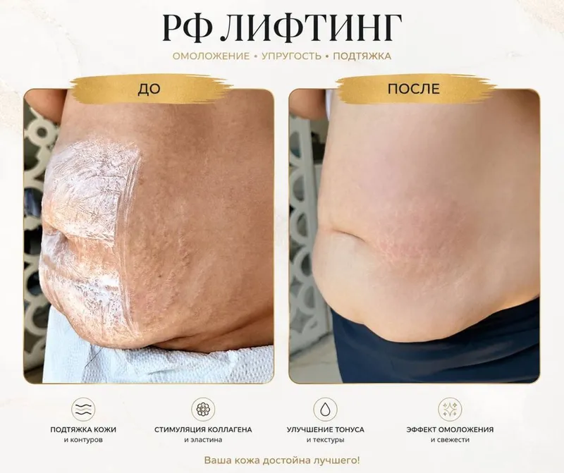 Подтяжка RF лифтинг После Беремености Растяжки подтяжка овала лица