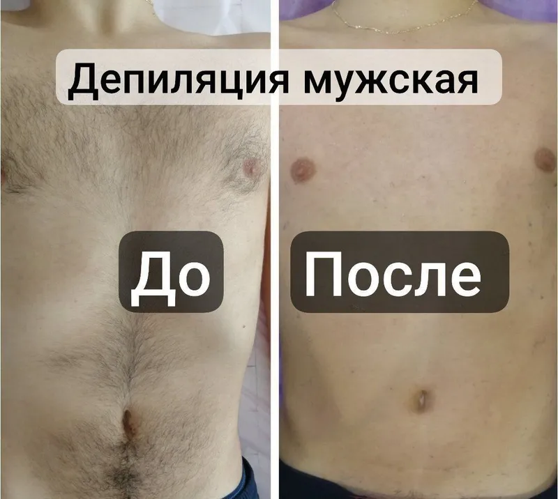 Депиляция епилатсия еркалар ва аёлар ун 2