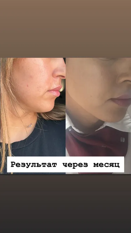 SMAS СМАС омоложение — фото 3