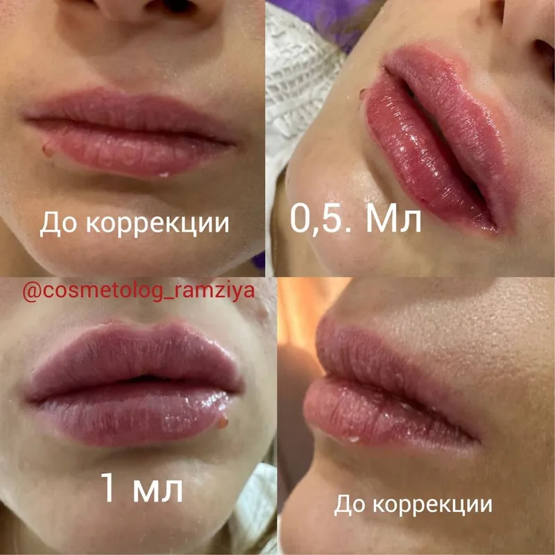 Губки , филлер, ботокс . Качественно! 3