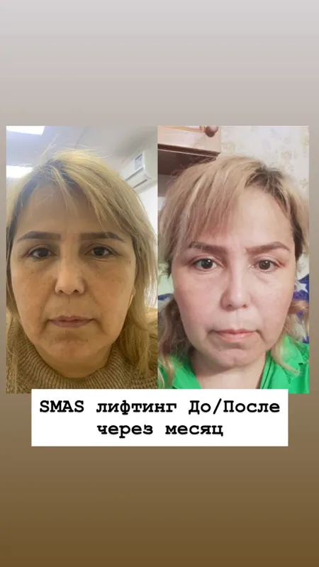 SMAS СМАС омоложение — фото 1