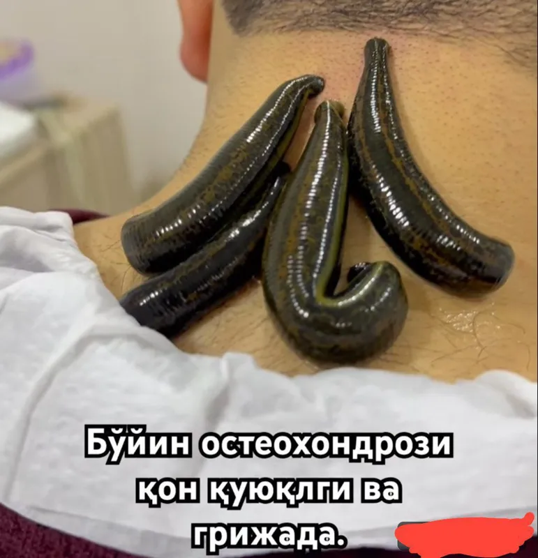 Хиджама, ставлю пиявки; лечение заболеваний 2