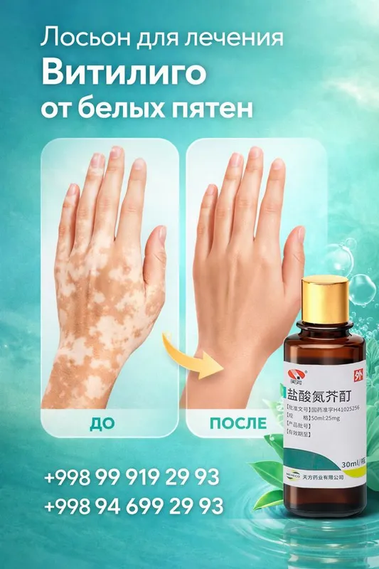Лосьон от витилиго. Vitiligo lasyon 3