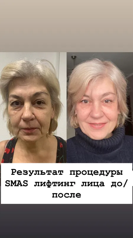 SMAS СМАС омоложение — фото 7