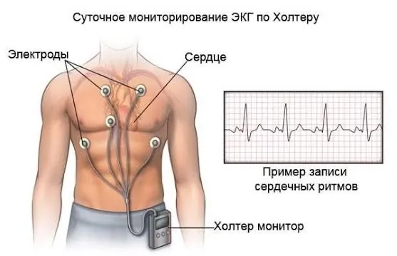Холтер экг мониторирования на дому 4