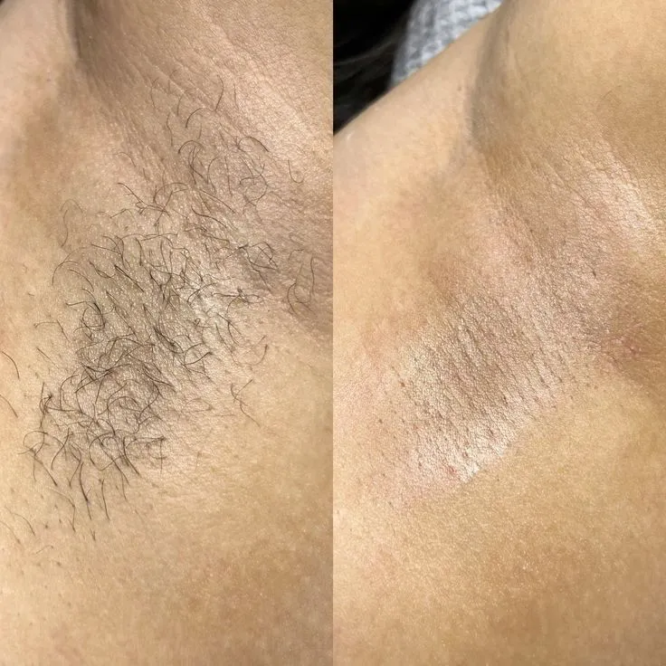 Chiska ayollar va erkaklarga laser epilyatsiya yuz chiskasi — фото 3