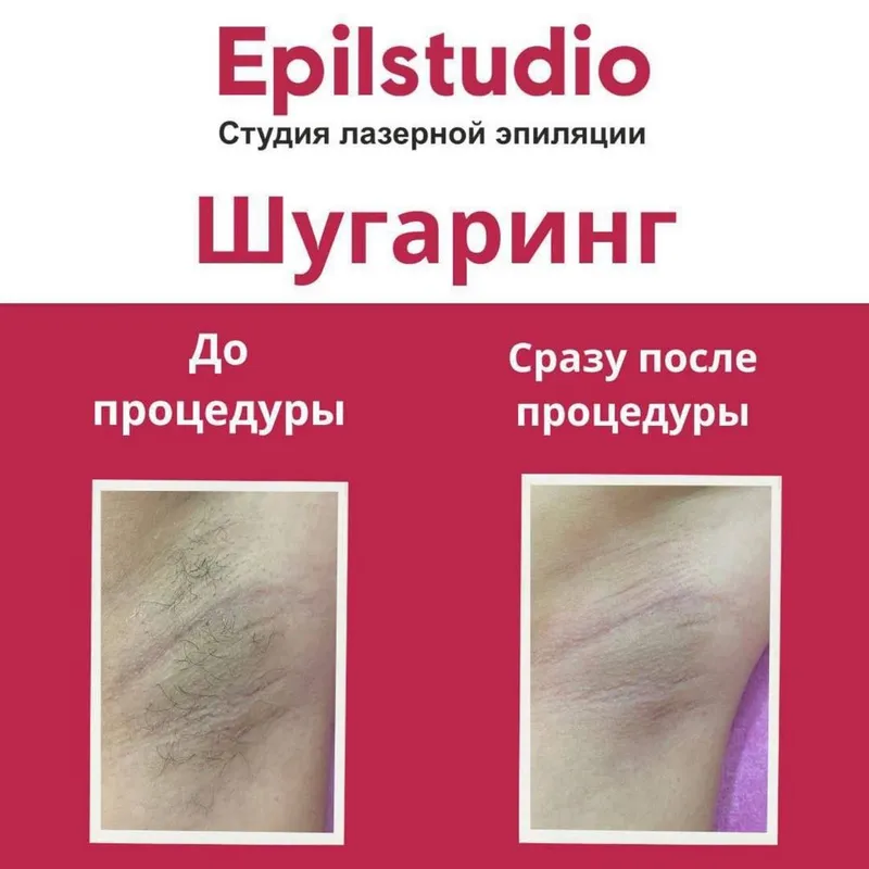 Удаление волос шугаринг Удаление волос шугаринг