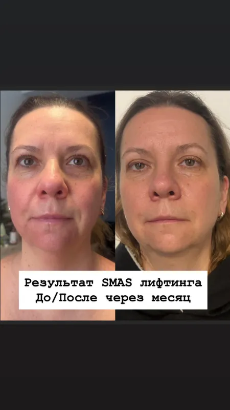 SMAS СМАС омоложение — фото 6