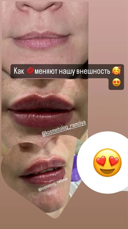 Губки , филлер, ботокс . Качественно! 2